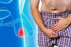 Cách nhận biết ung thư tinh hoàn - căn bệnh khó nói của cánh mày râu