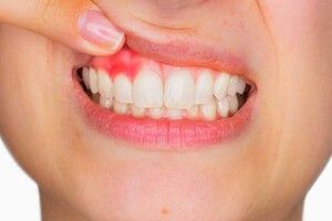 Đừng nên coi thường hiện tượng chảy máu chân răng của bệnh ung thư máu