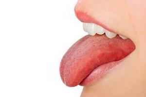 Những triệu chứng bệnh ung thư lưỡi dễ nhầm lẫn với nhiệt miệng