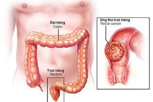 Cảnh giác với các dấu hiệu ung thư đại trực tràng - "sát thủ" trong nhóm bệnh nguy hiểm