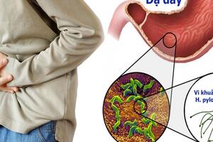 Tầm soát vi khuẩn HP – Nguyên nhân gây ung thư dạ dày