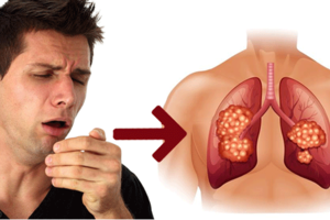 Những biểu hiện bất thường cảnh báo bệnh ung thư phổi đang tới gần