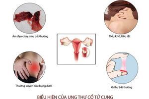 Ung thư cổ tử cung: triệu chứng nhận biết, bệnh có di truyền không?