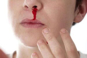 Ung thư máu giai đoạn đầu có dấu hiệu như thế nào và cách điều trị ra sao?
