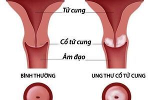 6 nguyên nhân gây ung thư cổ tử cung