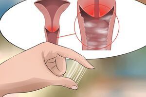 Những dấu hiệu ban đầu cảnh báo của bệnh ung thư cổ tử cung