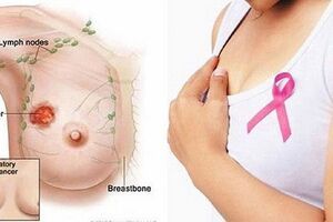 Các sản phẩm từ sữa và ung thư vú