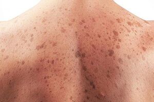 Điểm danh những dấu hiệu bất thường cảnh báo bệnh ung thư da