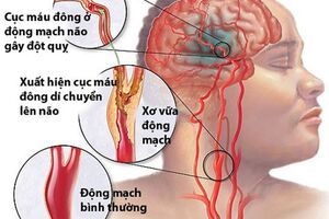 Bệnh đột quỵ: Nguyên nhân phổ biến bận nhất định phải biết