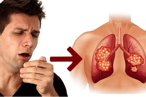 Sự thật về ung thư ở phụ nữ, bạn đã biết? (Phần 2)