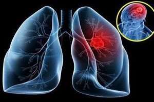 Ung thư phổi và các liệu pháp hỗ trợ chữa bệnh