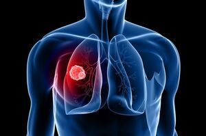 Những dấu hiệu đầu tiên của ung thư phổi