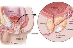Sự thật về ung thư: Phòng ngừa và tầm soát ung thư ở nam giới
