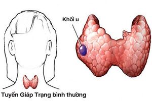 Có các loại ung thư tuyến giáp nào?